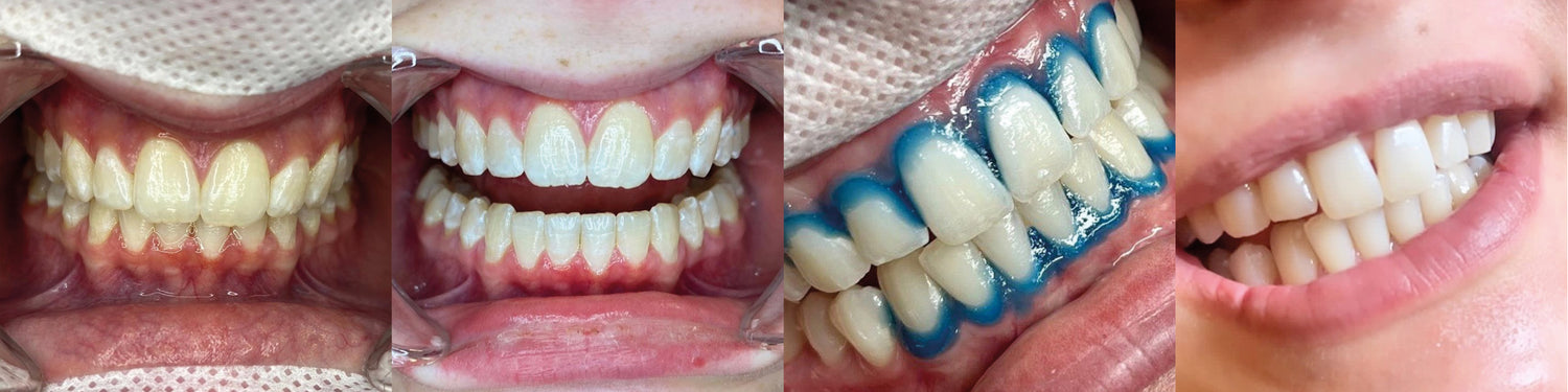 tanden bleken
tandenbleken
tanden witter maken
tanden bleachen
wittere tanden
tanden laten bleken
tanden bleachen prijs
tanden bleken prijs
bleaching tanden prijs
bleachen tanden