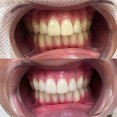 tanden bleken
tandenbleken
tanden witter maken
tanden bleachen
wittere tanden
tanden laten bleken
tanden bleachen prijs
tanden bleken prijs
bleaching tanden prijs
bleachen tanden